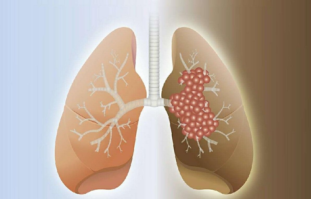不吸烟也患肺癌 肺癌诱发因素有哪些