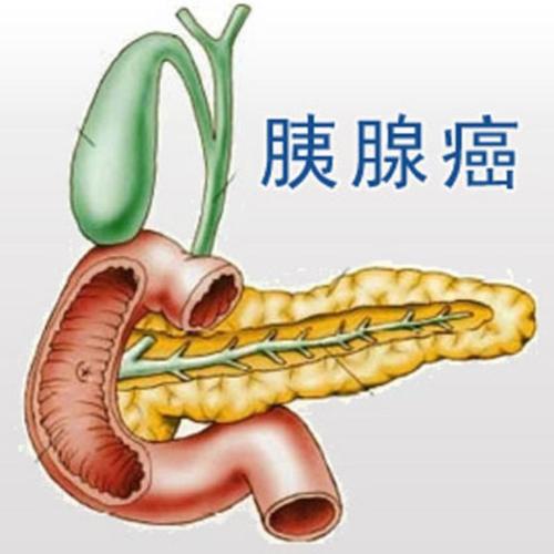 杭州御和堂中医院：突发糖尿病是胰腺癌的早期预警 胰腺癌