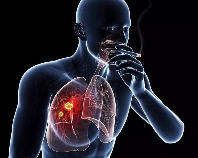 肺癌应该怎么预防？从戒烟开始。